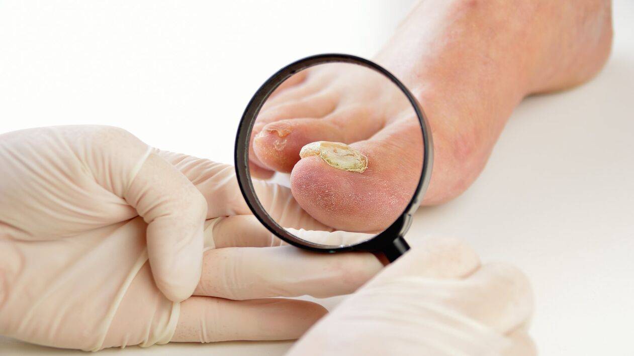 Treating Nail Fungus with Keramin Cream