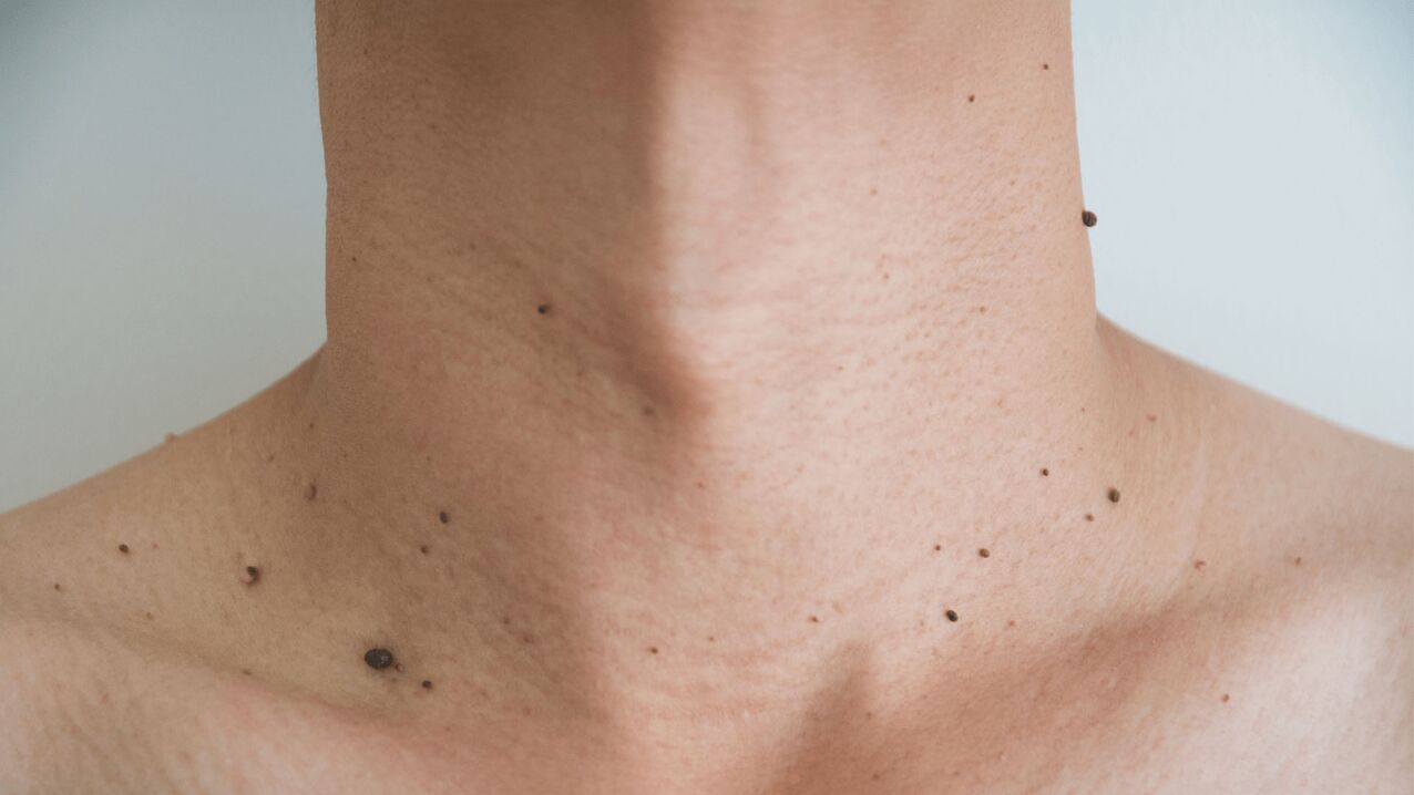 Treatment of Neck and Chest Papillomas with Keramin Cream