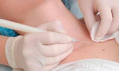 Methods for papilloma on the neck