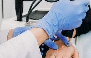 How to remove warts
