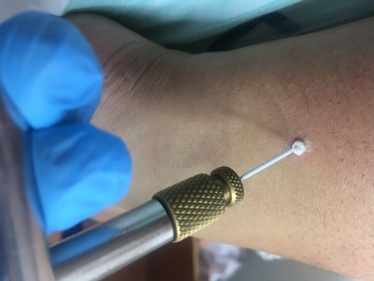How to remove warts