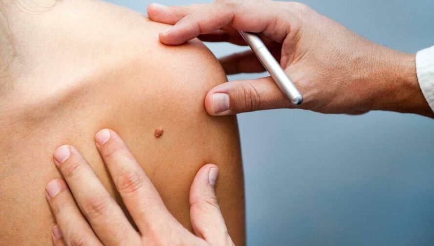Dermatologist examining patient with papilloma