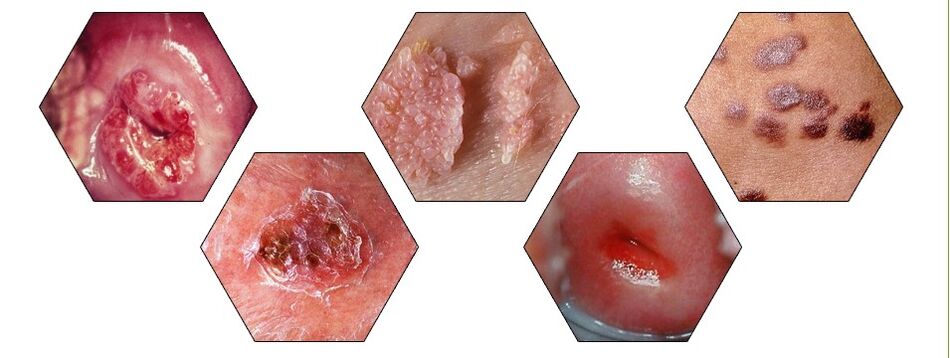 Dangerous Papilloma Types