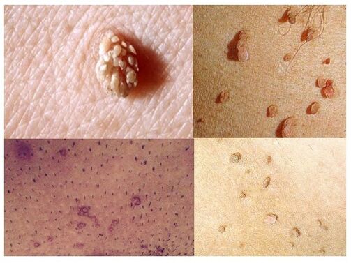 Genital warts on the body