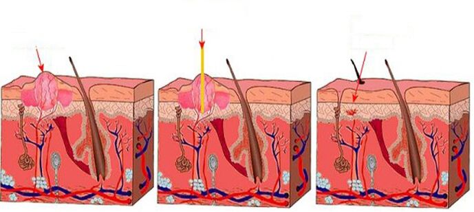 How does laser treat papilloma