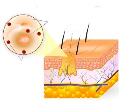 How warts grow