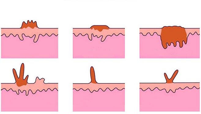 Types of Body Papillomas