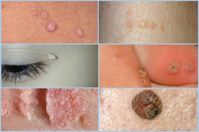 Types of facial and body papillomas