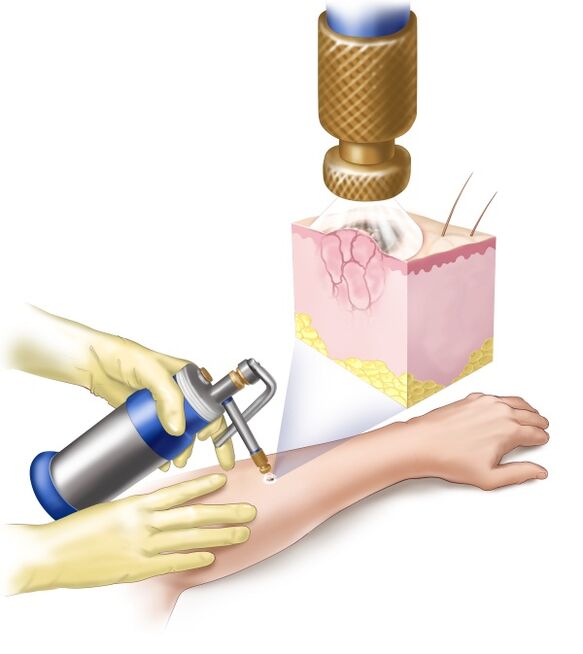 Using liquid nitrogen to remove papillomas