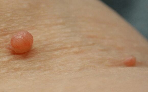 papilloma on body