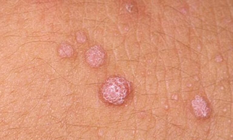 HPV causes skin papillomas