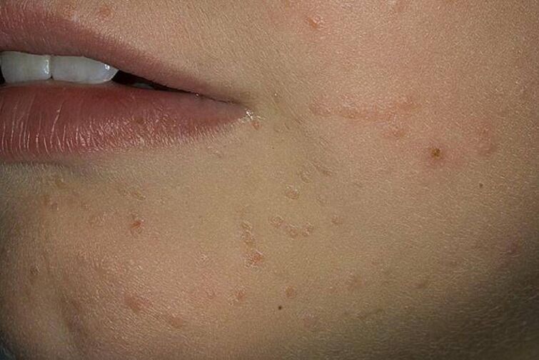 papilloma on face