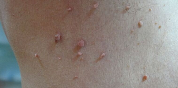 papilloma