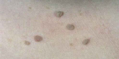 Flat warts on human skin