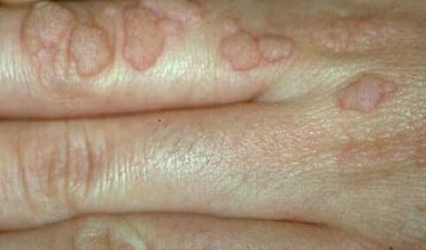 Human papillomavirus on hands