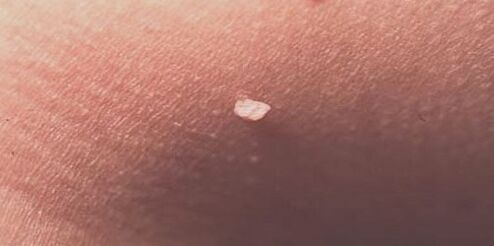 Human papillomavirus on skin
