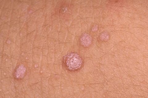 Human papillomavirus symptoms