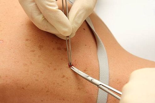 Professional wart removal