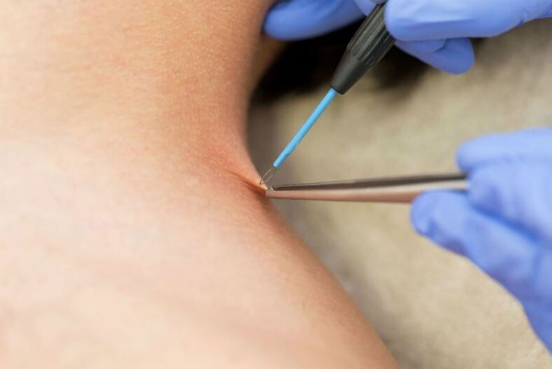 The process of removing papillomas using electrocoagulation
