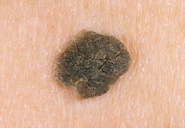 warts on the skin