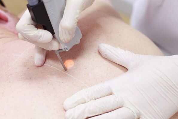 A popular method to remove papilloma with laser