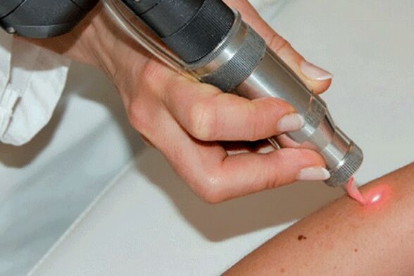 Laser Papilloma Removal