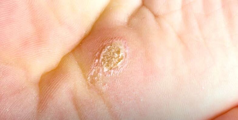 Plantar warts (vertebral warts)
