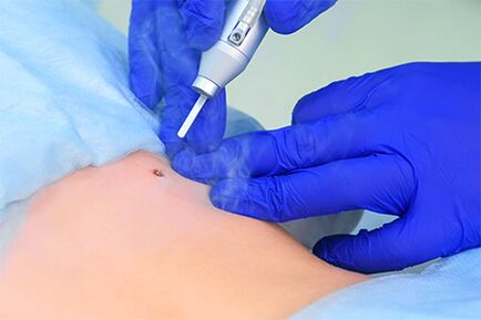 Laser Papilloma Resection