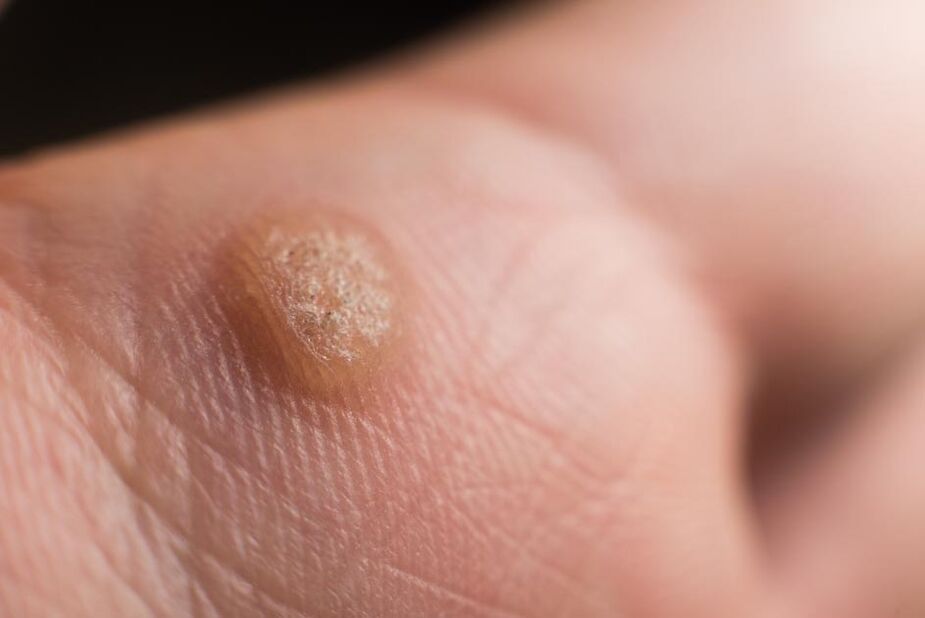HPV on the skin