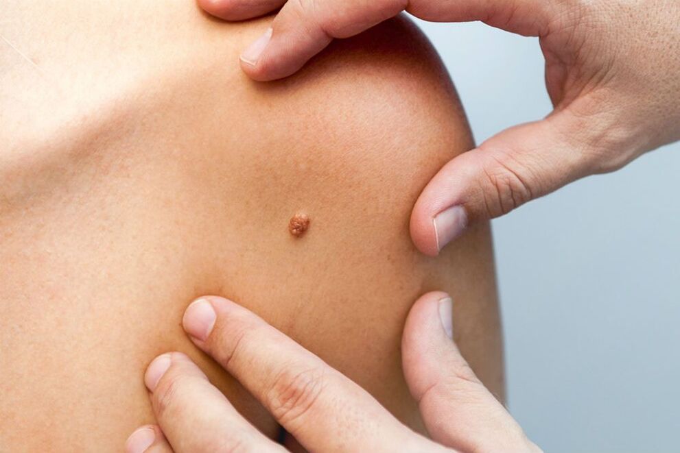 human papilloma
