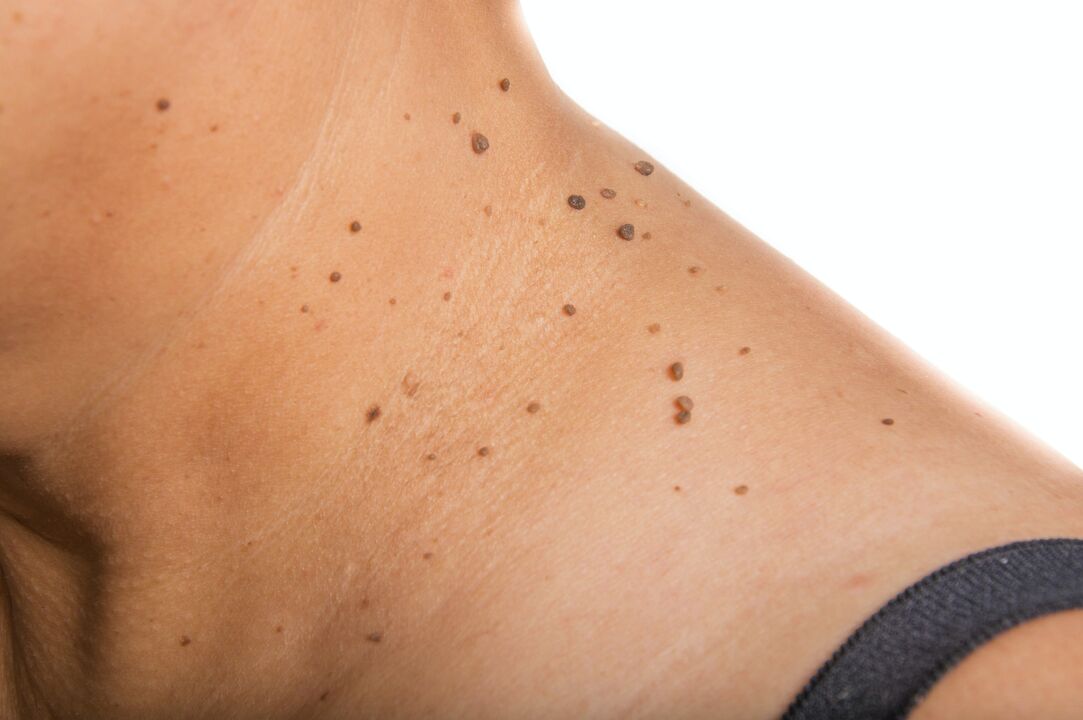 Disseminated papilloma of neck
