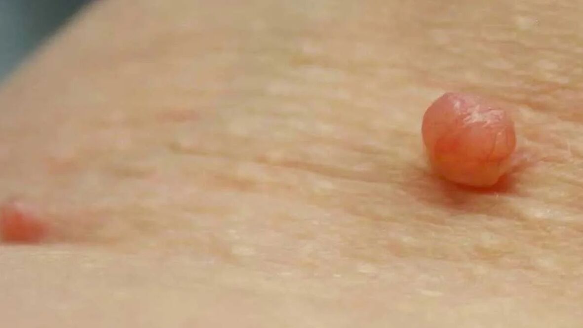 Papilloma removal at home