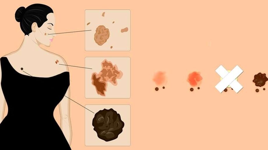 Types of human skin papillomas