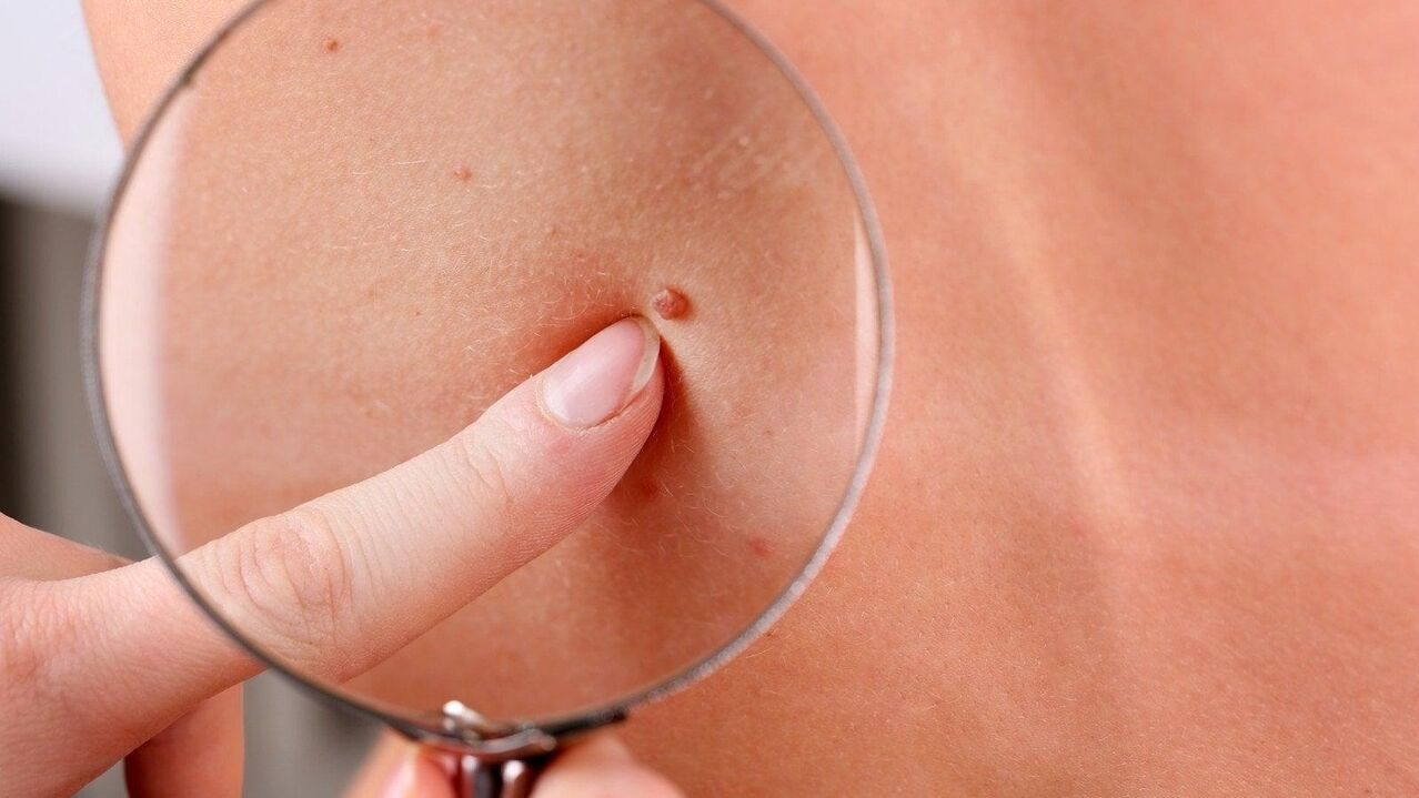 axillary papilloma
